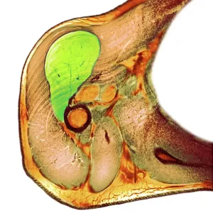 Lipoma of the shoulder, X-ray Lipoma of the shoulder, X-ray