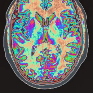 MRI scan of brain