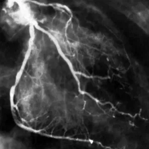 Narrowed coronary arteries (B&W) Narrowed coronary arteries (B&W)