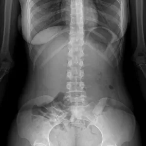 Normal abdomen, X-ray