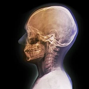 Normal childs head, X-ray