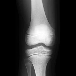 Normal childs knee, X-ray