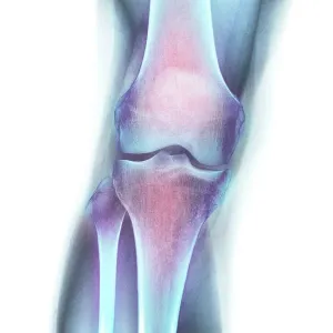 Normal knee, X-ray Normal knee, X-ray
