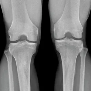 Normal knees, X-ray