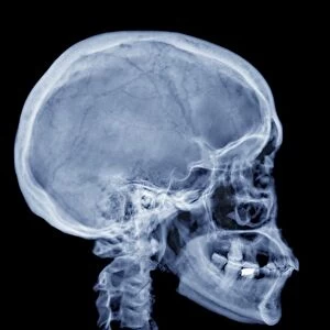 Normal skull, X-ray
