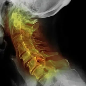 Osteoarthritis of the cervical spine, X-ray Osteoarthritis of the cervical spine, X-ray