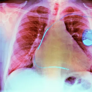 Pacemaker in heart disease, X-ray