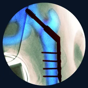 Pinned fractured hip, X-ray Pinned fractured hip, X-ray