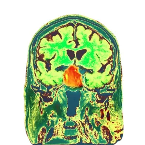 Pituitary tumour, CT scan Pituitary tumour, CT scan