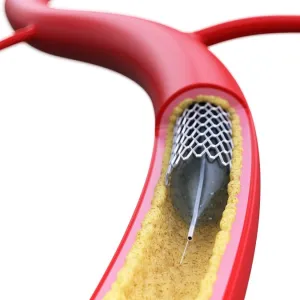 Stent inside of an artery, illustration