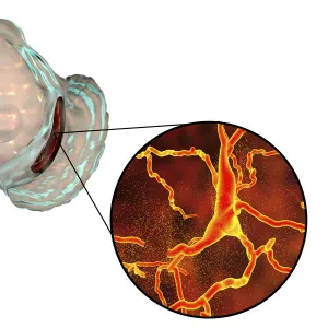 Substantia nigra in Parkinsons disease, illustration