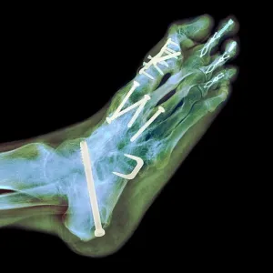 Surgical fixation for rheumatoid arthritis of feet, X-ray Surgical fixation for rheumatoid arthritis of feet, X-ray