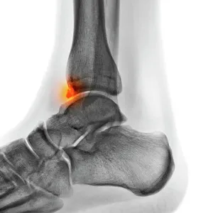 Tibial spur, X-ray Tibial spur, X-ray