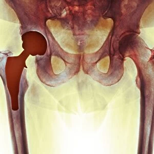 Total hip replacement, X-ray