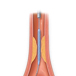 Vessel occluded with plaque with stent in place