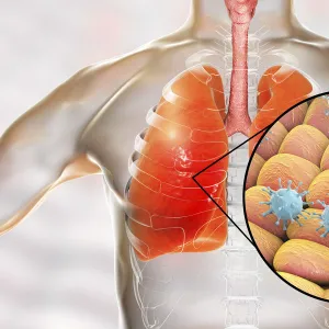 Viral pneumonia, conceptual illustration