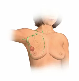 Images Dated 2nd June 2010: Anterior view female anatomy showing breast tissue with a tumor
