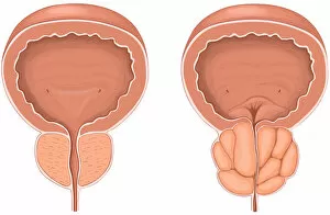Anterior view showing normal versus enlarged prostate gland