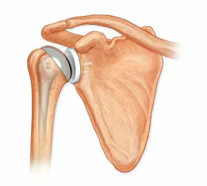 Biology Gallery: Anterior view total shoulder joint repair