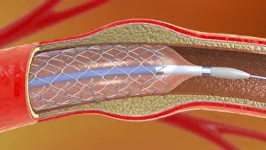 Arterial stent, illustration