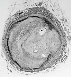 Blood Vessel Prints: Arteries Choked By Plaque, Cholesterol
