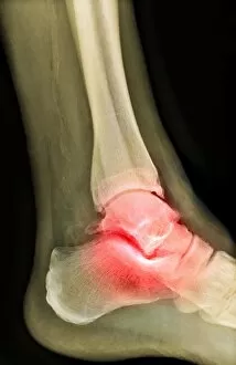 Images Dated 14th April 2010: Arthritic ankle, X-ray