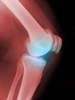 Images Dated 14th April 2010: Arthritic knee, X-ray