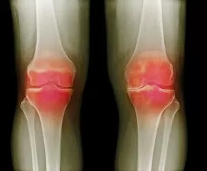 Images Dated 14th April 2010: Arthritic knees, X-ray