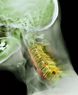 Arthritis of the neck, X-ray