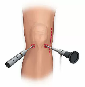 Images Dated 5th January 2012: Arthroscopic surgical repair of the knee