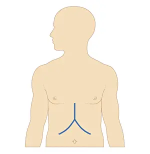 Liver Prints: Biomedical illustration of incision site for liver transplant