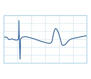 Graph Prints: Biomedical illustration of nerve conduction trace
