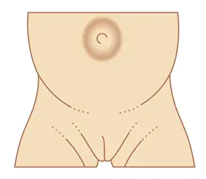 Babies Only Prints: Biomedical illustration of umbilical hernia in female baby