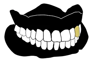 Black and white digital illustration of set of dentures with gold tooth amid white teeth