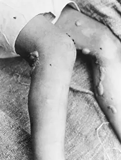 The Blistered Legs of a Chinese Soldier