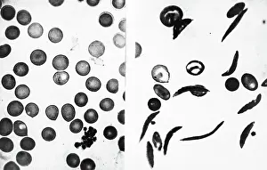 Disease Prints: Blood Cells - Normal And Sickle