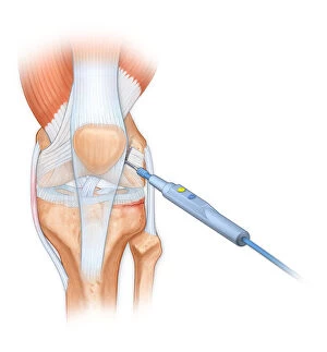 Images Dated 28th July 2012: Bovie used to cut through retincaculum, and clean up femur of Displaced patellar knee