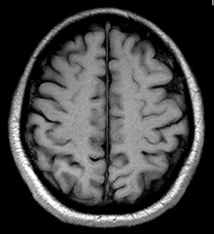 Images Dated 26th June 2012: Brain MRI