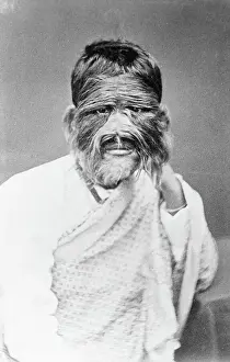 Daughter Prints: Burmese Woman with Congenital Hypertrichosis Lanuginosa