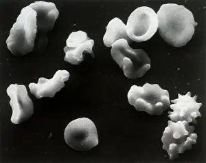 Prints of (Original Caption). Berkeley, CA- Both normal red blood cells (center foreground and upper right) and deformed cells can be seen in this sample of blood taken from a person with sickle cell anemia Pioneers of Science: Cells Deformed by Sickle Cell Anemia