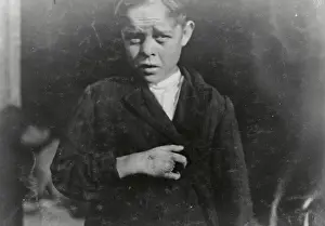 Laborer Prints: Child Laborer Who Lost Two Fingers in Accident