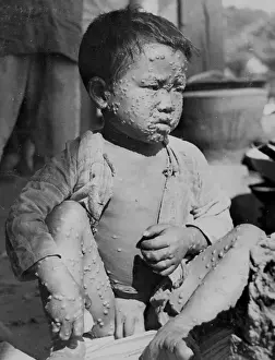 Smallpox Prints: Child Suffering from Smallpox