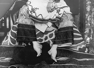 Chinese Woman Showing Emaciated Deformed Feet
