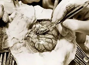 Surgery Prints: Closeup Of Brain Surgery; Brain Visible