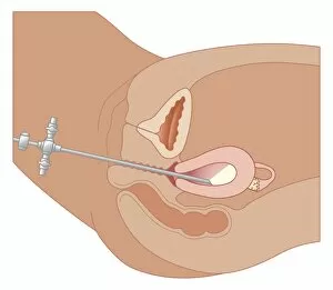 Images Dated 21st October 2011: Cross section biomedical illustration of hysteroscopy examination using endoscope