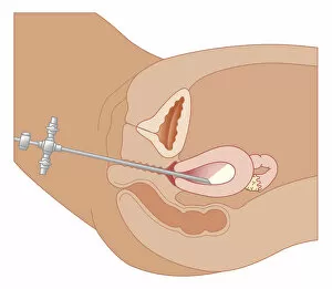 Images Dated 21st October 2011: Cross section biomedical illustration of hysteroscopy procedure using endoscope