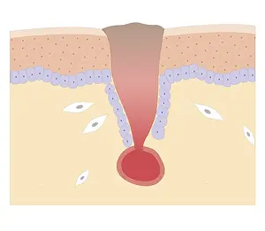 Wounded Prints: Cross section biomedical illustration of blood clotting over broken skin and fibroblasts multiplying
