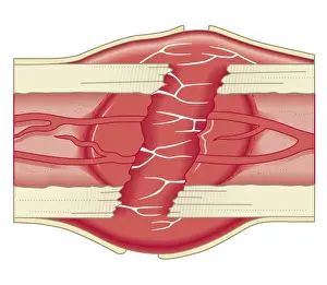 Human Tissue Prints: Cross section biomedical illustration of bone repairing itself with clot forming to seal broken blood vessels