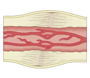 Recovery Prints: Cross section biomedical illustration of bone repairing itself with dense