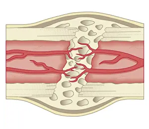 Softness Prints: Cross section biomedical illustration of bone repairing itself with new